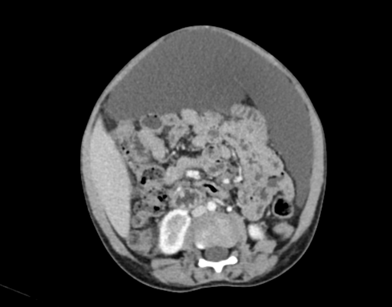 Abdominal premesenteric cystic lymphangioma (Radiopaedia 82995-97350 Axial C+ portal venous phase 32).jpg