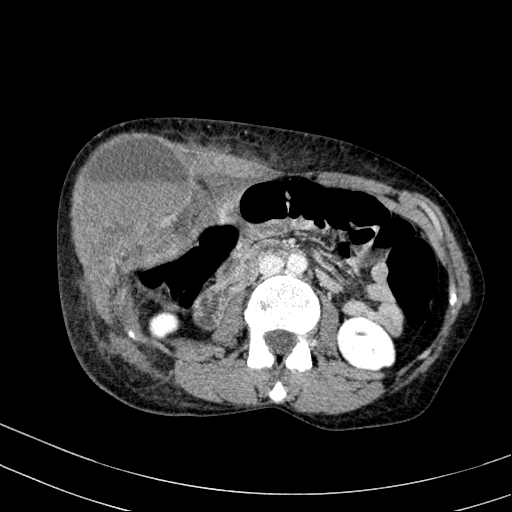 Abdominal wall hematoma with active bleeding (Radiopaedia 83915-99117 Axial C+ portal venous phase 38).jpg