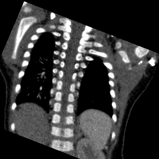 File:Aberrant left pulmonary artery (pulmonary sling) (Radiopaedia 42323-45435 Coronal C+ CTPA 6).jpg