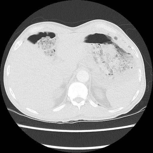 Accessory left horizontal fissure with lingular pneumonia (Radiopaedia 53763-59843 Axial lung window 52).jpg
