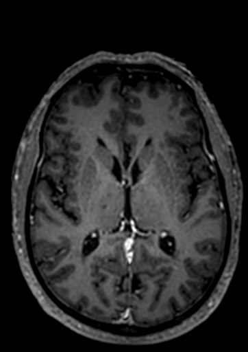 Accessory middle cerebral artery (Radiopaedia 73114-83828 Axial T1 C+ 25).jpg