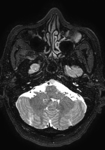 File:Accessory middle cerebral artery (Radiopaedia 73114-83828 Axial T2 176).jpg