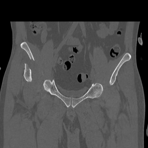 Acetabular and ilial fractures (Radiopaedia 59084-66378 Coronal bone window 17).jpg