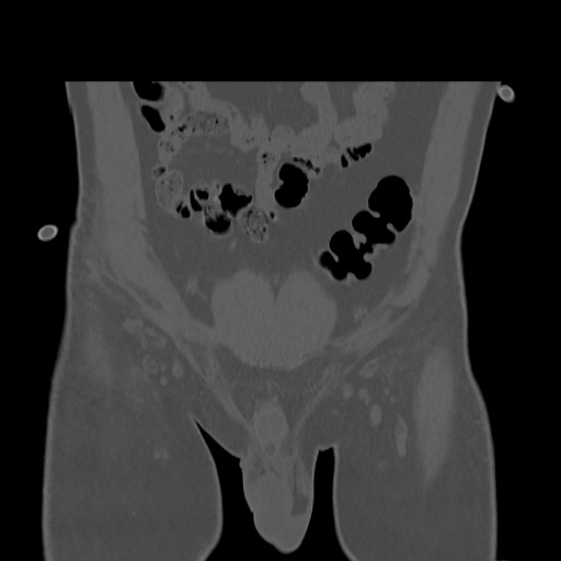 Acetabular and ilial fractures (Radiopaedia 59084-66378 Coronal bone window 5).jpg