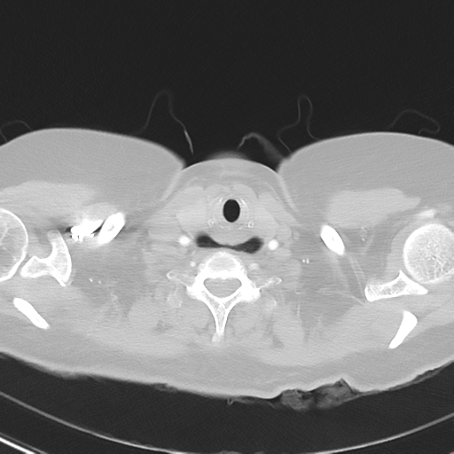 File:Achalasia (Radiopaedia 47147-51685 Axial lung window 1).png