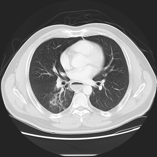 Achalasia (Radiopaedia 8831-9629 Axial lung window 34).jpg