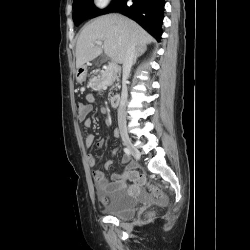Acinar cell carcinoma of the pancreas (Radiopaedia 75442-86669 Sagittal C+ portal venous phase 85).jpg
