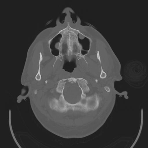 File:Acoustic schwannoma (Radiopaedia 29488-29982 AXIAL BONE THICK non-contrast 3).jpg
