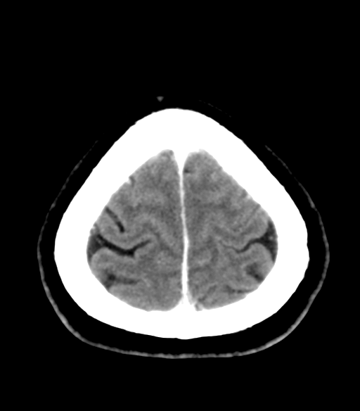File:Acoustic schwannoma (Radiopaedia 33045-34065 Axial C+ delayed 25).png