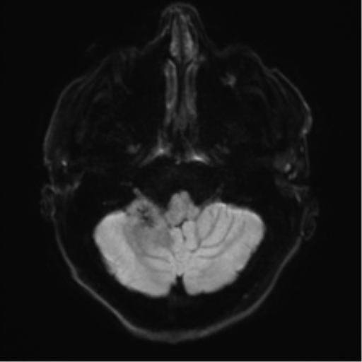 Acoustic schwannoma (Radiopaedia 50846-56358 Axial DWI 32).png