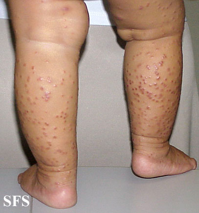 File:Acrodermatitis Infantile Papular (Dermatology Atlas 12).jpg