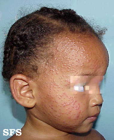 Acrodermatitis Infantile Papular (Dermatology Atlas 5).jpg