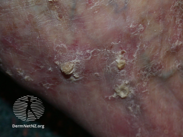 File:Actinic keratoses affecting the legs and feet (DermNet NZ lesions-ak-legs-477).jpg