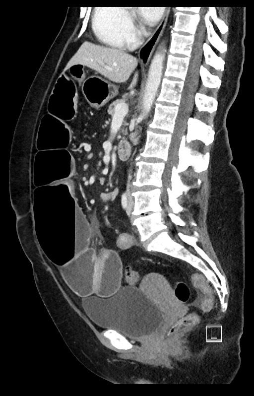 Active Crohn disease (Radiopaedia 59394-66750 Sagittal C+ portal venous phase 29).jpg