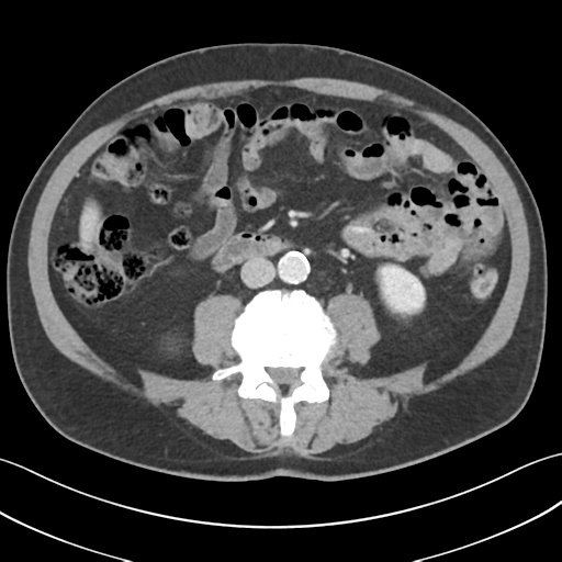 File:Active diverticular hemorrhage (Radiopaedia 39415-41725 Axial C+ portal venous phase 35).png