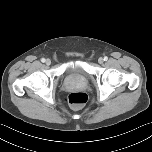 File:Active diverticular hemorrhage (Radiopaedia 39415-41725 Axial C+ portal venous phase 69).png