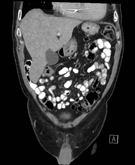 Active lower gastrointestinal bleeding - diverticular (Radiopaedia 61203-69106 Coronal C+ portal venous phase 39).jpg