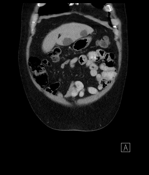 Acute-on-chronic pancreatitis (Radiopaedia 67286-76656 Coronal C+ portal venous phase 19).jpg