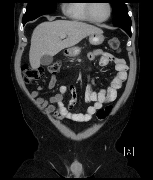 Acute-on-chronic pancreatitis (Radiopaedia 67286-76656 Coronal C+ portal venous phase 28).jpg