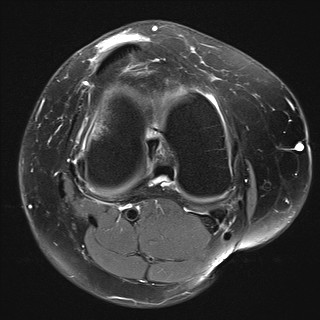 File:Acute-on-chronic transient lateral patellar dislocation with trochlear dysplasia (Radiopaedia 84099-99349 Axial PD fat sat 20).jpg