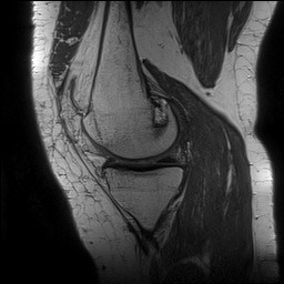 Acute-on-chronic transient lateral patellar dislocation with trochlear dysplasia (Radiopaedia 84099-99349 Sagittal PD 61).jpg