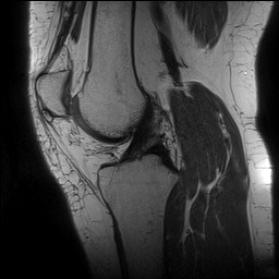 Acute-on-chronic transient lateral patellar dislocation with trochlear dysplasia (Radiopaedia 84099-99349 Sagittal PD 84).jpg
