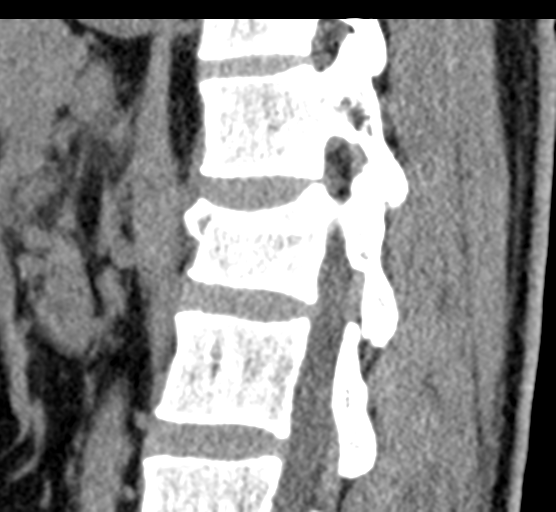 File:Acute L1 burst compression fracture (Radiopaedia 34430-35755 E 56).png