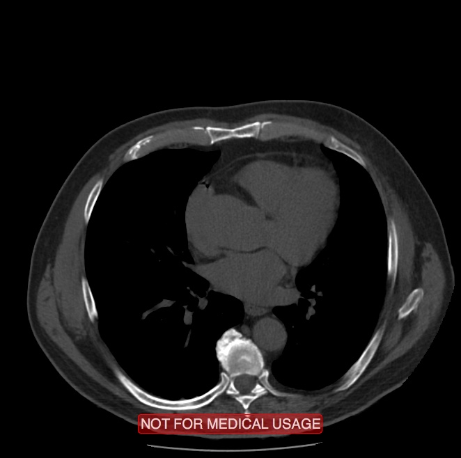 Acute aortic dissection - Stanford type A (Radiopaedia 40661-43285 Axial non-contrast 35).jpg
