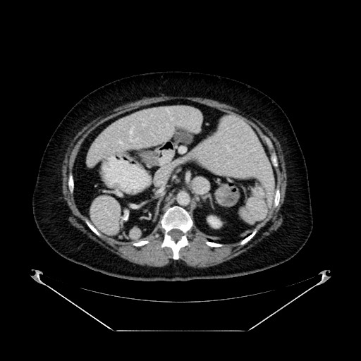 Acute appendicitis, heterotaxy syndrome (Radiopaedia 66884-76202 Axial C+ portal venous phase 41).jpg