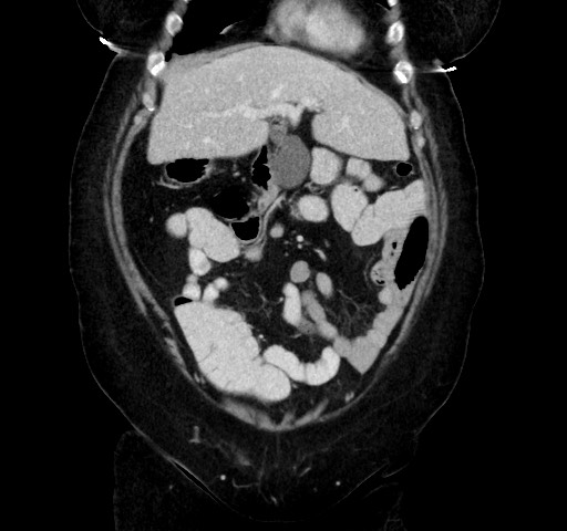 Acute appendicitis, heterotaxy syndrome (Radiopaedia 66884-76202 Coronal C+ portal venous phase 32).jpg
