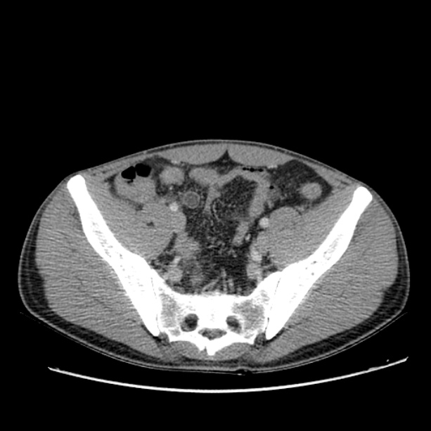 Acute appendicitis (Radiopaedia 27049-27227 Axial C+ portal venous phase 59).jpg