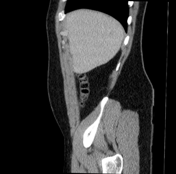 Acute appendicitis (Radiopaedia 38255-40270 Sagittal C+ portal venous phase 13).jpg