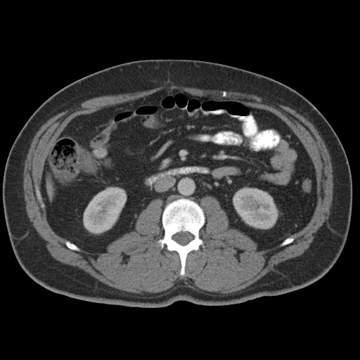 Acute appendicitis (Radiopaedia 48511-53463 Axial C+ portal venous phase 47).jpg