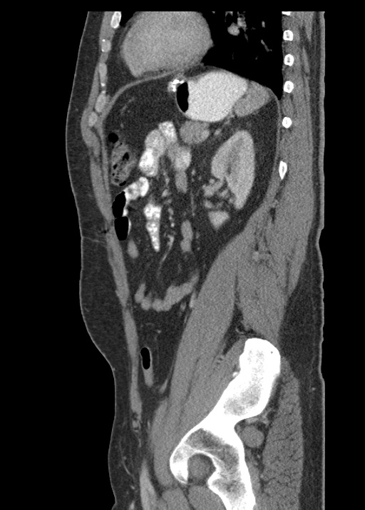 Acute appendicitis (Radiopaedia 48511-53463 Sagittal C+ portal venous phase 92).jpg