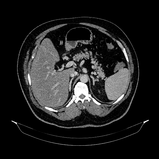File:Acute appendicitis (Radiopaedia 79950-93224 Axial C+ portal venous phase 31).jpg