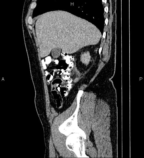 Acute appendicitis (Radiopaedia 84780-100240 Sagittal C+ portal venous phase 19).jpg
