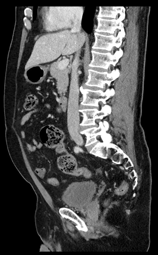 Acute appendicitis - large appendicoliths (Radiopaedia 61805-69820 Sagittal C+ portal venous phase 63).jpg