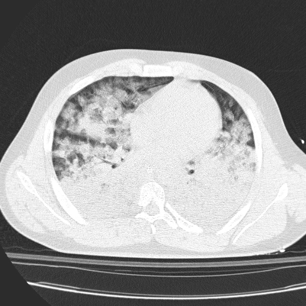 Acute aspiration pneumonitis (Radiopaedia 33605-34703 Axial lung window 55).jpg
