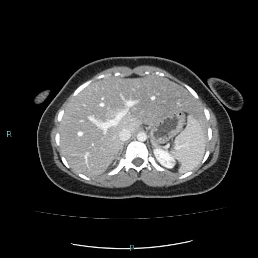 Acute bilateral pyelonephritis (Radiopaedia 37146-38881 Axial C+ portal venous phase 23).jpg