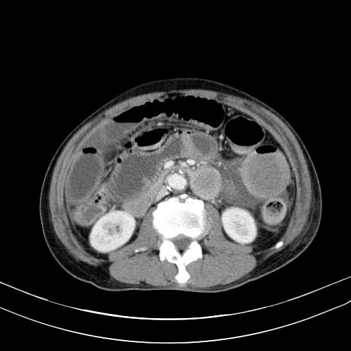 Acute bowel ischemia (Radiopaedia 87695-104114 Axial C+ portal venous phase 40).jpg