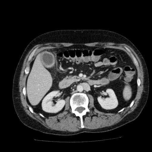 File:Acute cholecystitis and incidental left sided IVC (Radiopaedia 49352-54459 Axial C+ portal venous phase 66).jpg