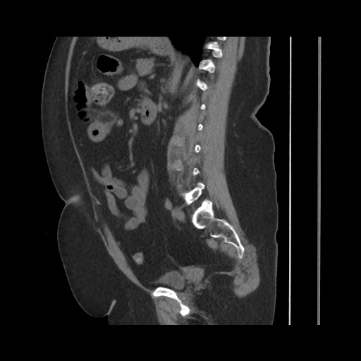 File:Acute cholecystitis with tensile fundus sign (Radiopaedia 71394-81723 Sagittal non-contrast 100).jpg