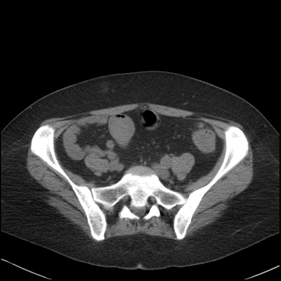 Acute colonic hemorrhage in ulcerative colitis (Radiopaedia 77415-89538 Axial non-contrast 99).jpg