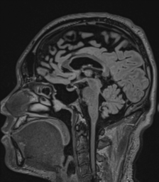 Acute disseminated encephalomyelitis (ADEM)- Anti-NMDA receptor encephalitis (Radiopaedia 54920-61201 Sagittal FLAIR 43).png