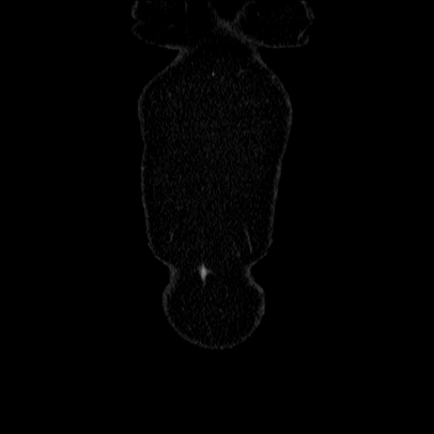 Acute diverticulitis (Radiopaedia 34183-35442 Coronal C+ portal venous phase 4).jpg