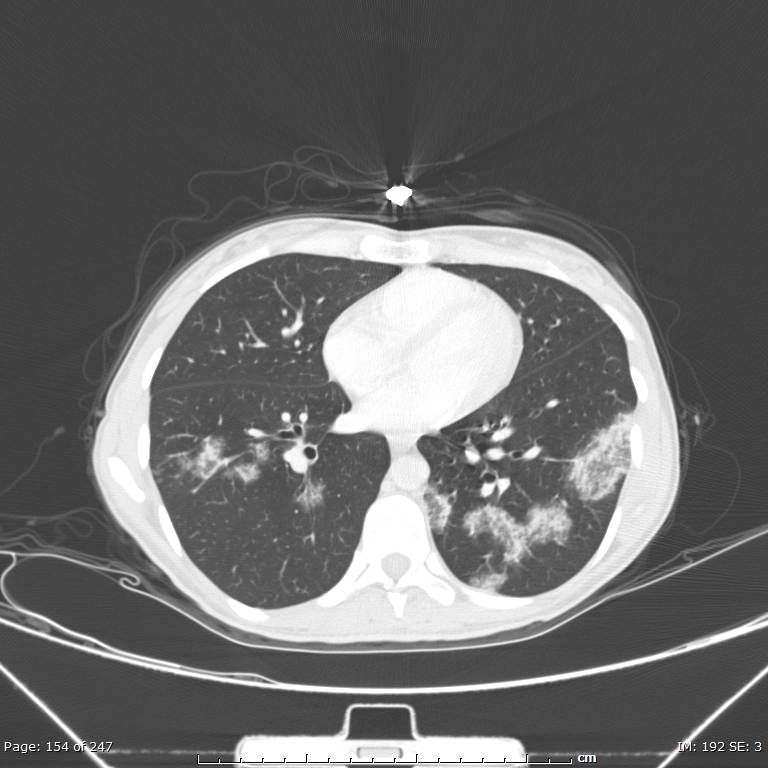 Acute eosinophilic pneumonia (Radiopaedia 48211-53073 Axial lung window 55).jpg