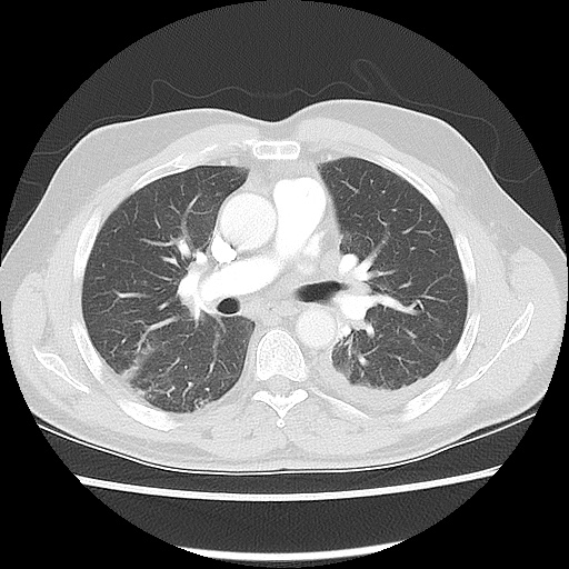 Acute epicardial fat necrosis (Radiopaedia 42327-45440 Axial lung window 29).jpg