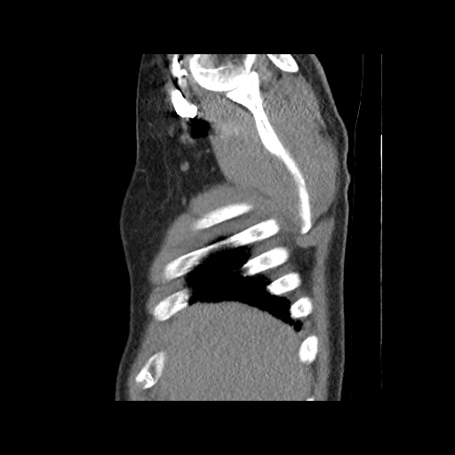 Acute epicardial fat necrosis (Radiopaedia 42327-45440 Sagittal C+ CTPA 11).jpg