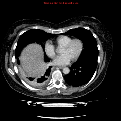 Acute gangrenous cholecystitis (Radiopaedia 10123-10661 Axial C+ portal venous phase 4).jpg