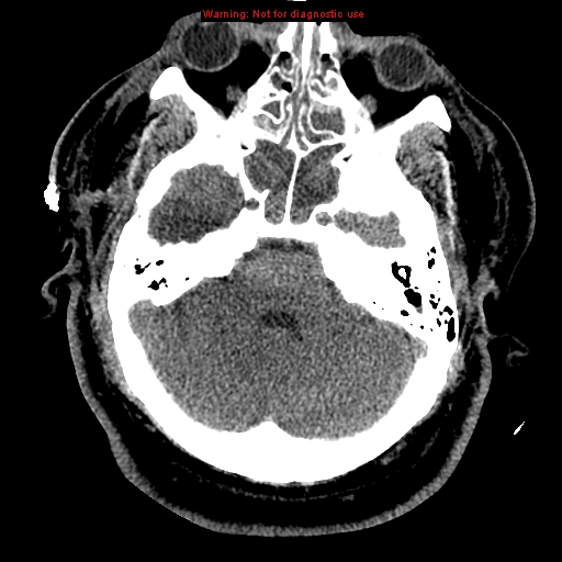 Acute hemorrhagic leukoencephalitis (Radiopaedia 14076-43697 Axial non-contrast 11).jpg